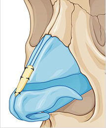 Derotation-graft-with-ear-cartilage