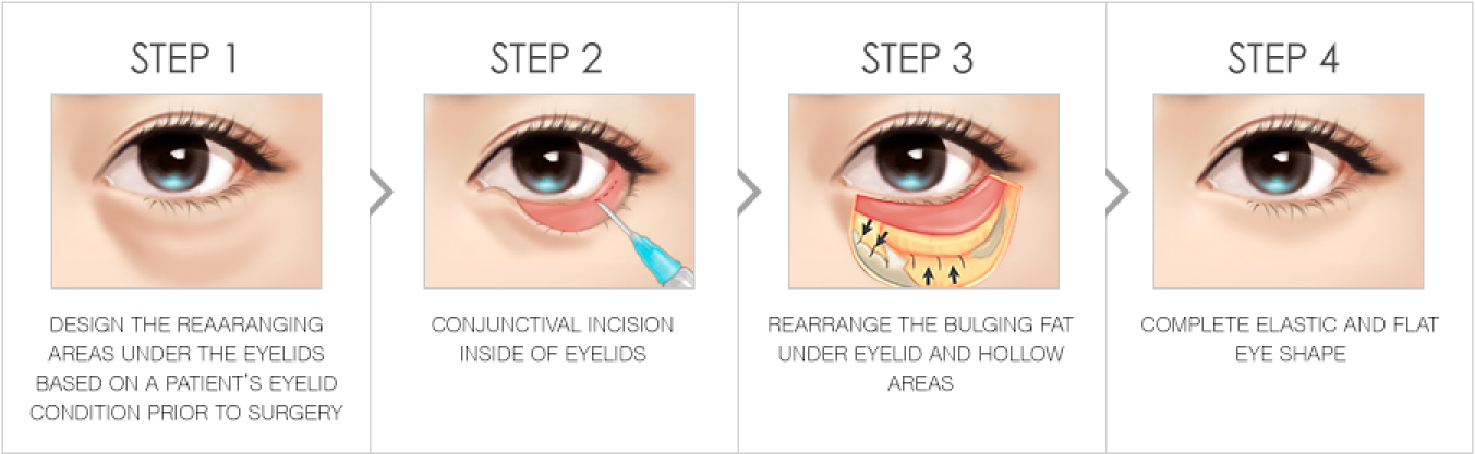 Центр веко. Tattoo the inside of an eyelid. What methods help to correct the lower eyelids?.