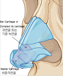 Hybrid-septal-cartilage-graft-with-ear-cartilage