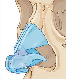 Septal-extension-graft-with-septal-cartilage