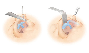 autologous-cartilage-graft-1