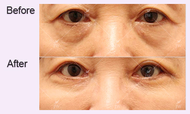 eye-revision-surgery-jw-plastic-surgery-clinic-korea-1