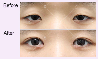 eye-revision-surgery-jw-plastic-surgery-clinic-korea-10