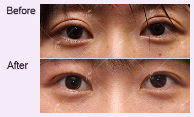 eye-revision-surgery-jw-plastic-surgery-clinic-korea-11