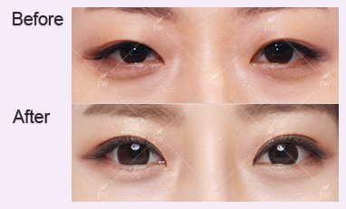 eye-revision-surgery-jw-plastic-surgery-clinic-korea-13