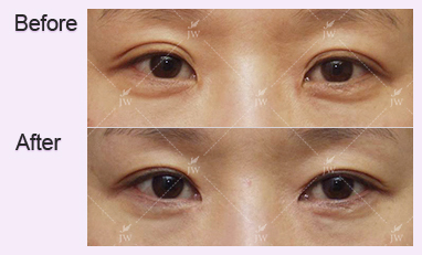 eye-revision-surgery-jw-plastic-surgery-clinic-korea-14