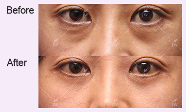 eye-revision-surgery-jw-plastic-surgery-clinic-korea-2