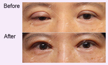 eye-revision-surgery-jw-plastic-surgery-clinic-korea-3
