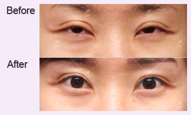 eye-revision-surgery-jw-plastic-surgery-clinic-korea-4