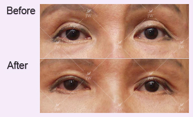 eye-revision-surgery-jw-plastic-surgery-clinic-korea-5