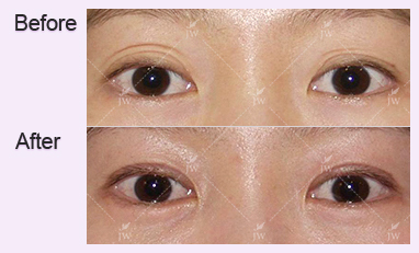 eye-revision-surgery-jw-plastic-surgery-clinic-korea-7