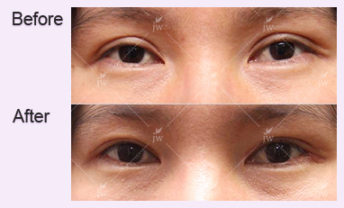 eye-revision-surgery-jw-plastic-surgery-clinic-korea-8