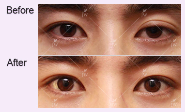 eye-revision-surgery-jw-plastic-surgery-clinic-korea-9
