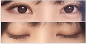 eye-revision-surgery-jw-plastic-surgery-clinic