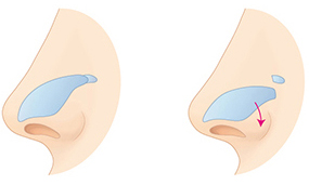 repositioning-of-alar-cartilage-1