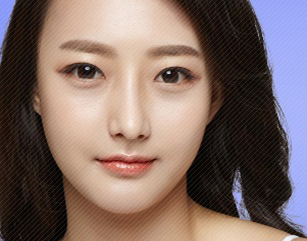 V Line Surgery In Korea (Jaw Surgery)