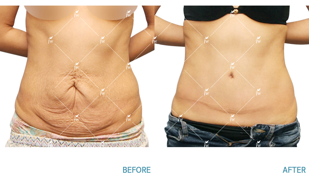 Before After body contouring korea