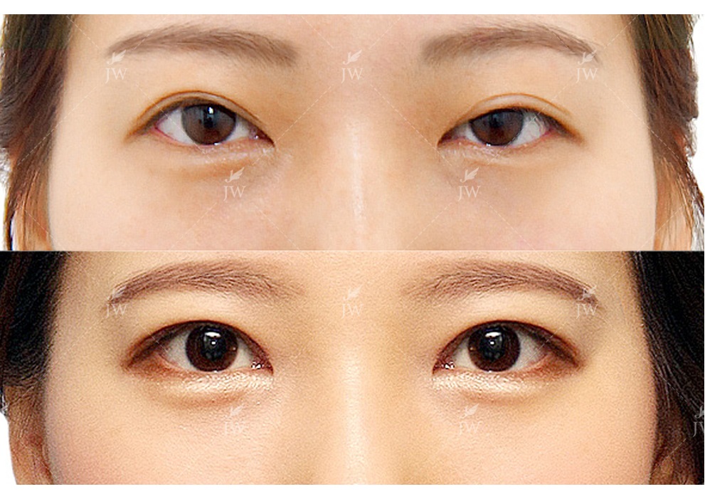Ptosis Correction Double Eyelid Surgery 2 1 