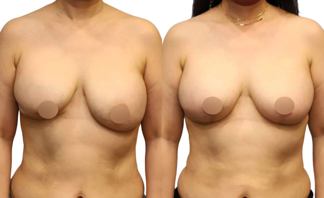 почему у женщин увеличивается грудь фото 115
