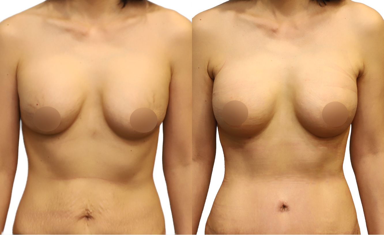 как делают пластическую операцию груди женщин фото 11